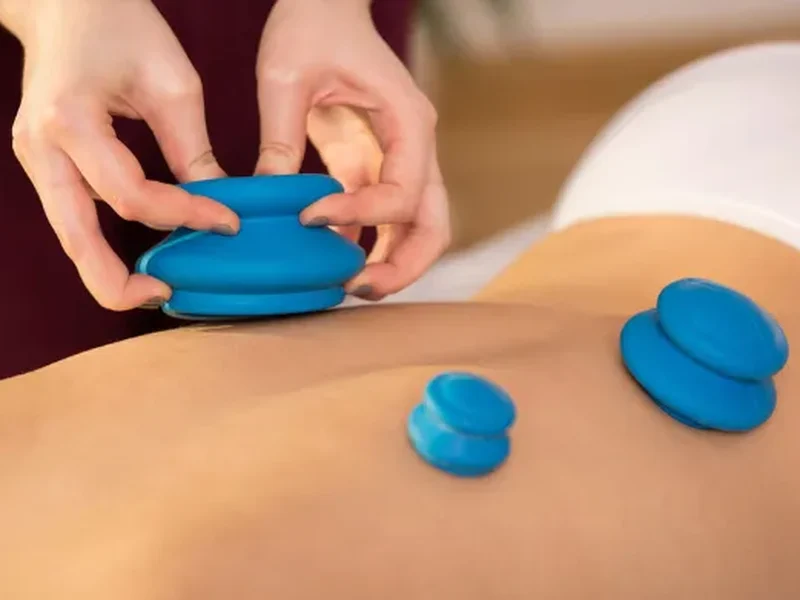 Doctor of Physical Therapy performing cupping therapy on a patient's shoulder