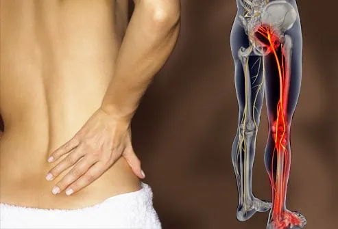 Buttock Pain Causes Treatment and When to Seek Medical Care