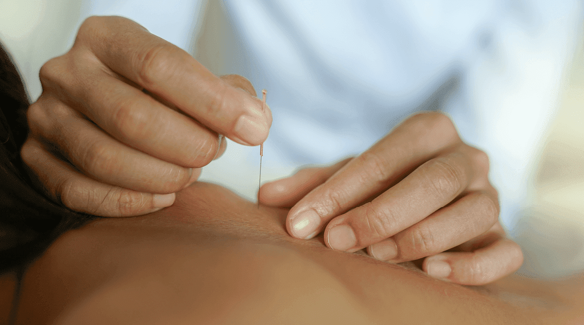 What should you not do after dry needling?