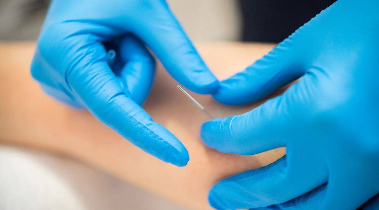 will dry needling help tennis elbow Simply Physio