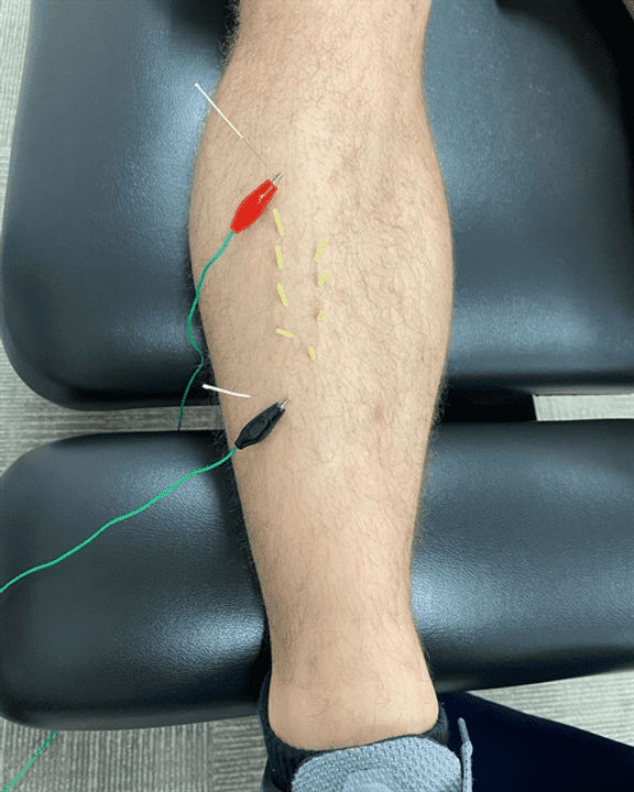 Why do I feel worse after dry needling?