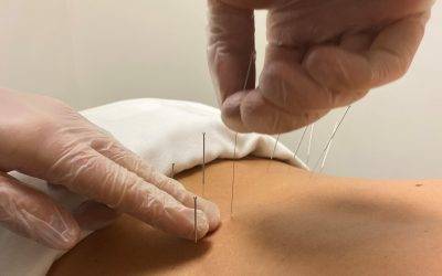 The Benefits of Dry Needling in Physical Therapy Treatments