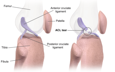 The Truth Behind ACL Popping Sensations: Should You Be Worried?