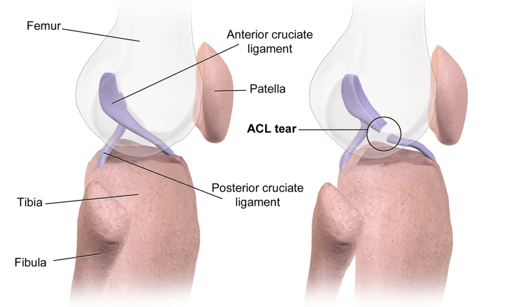 The Truth Behind ACL Popping Sensations Should You Be Worried