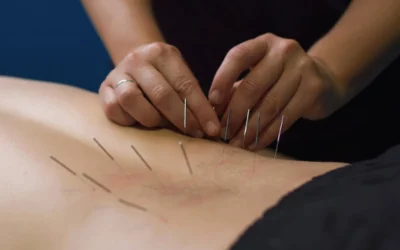 What Is Dry Needling? Your Complete Guide to This Powerful Pain-Relief Tool
