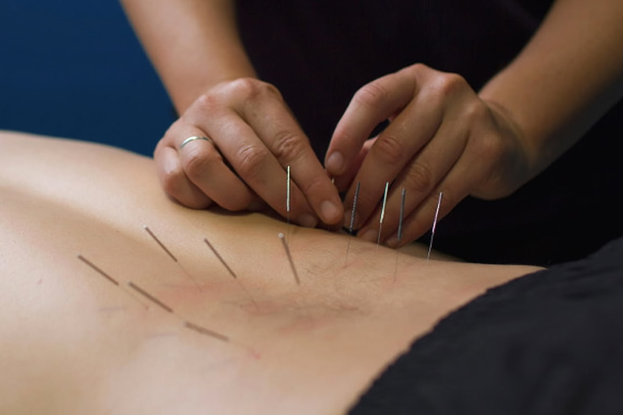 What is Dry Needling