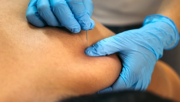 Dry Needling - Simply Physio